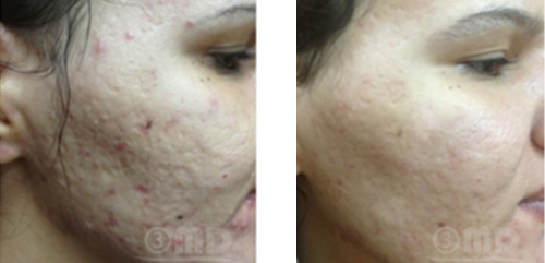 Acne scarring before and after - courtesy Dr. Hasan El-Fakahany