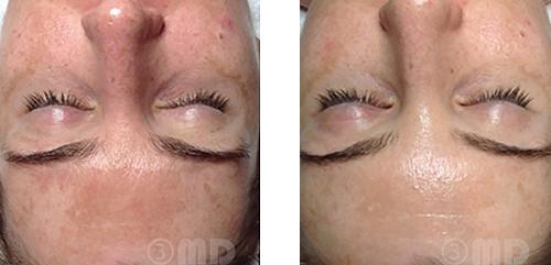 Melasma management before and after - courtesy Bella Pelle Clinic