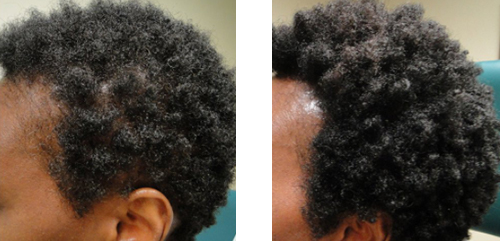 45 year old female 7 Platelet Rich Plasma hair restore treatments - courtesy Jeffrey Rapaport